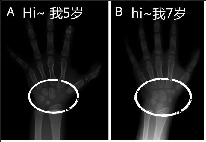 骨龄检测是通过拍摄左手腕正位x线片,观察腕骨,掌骨,指骨的发育形态来